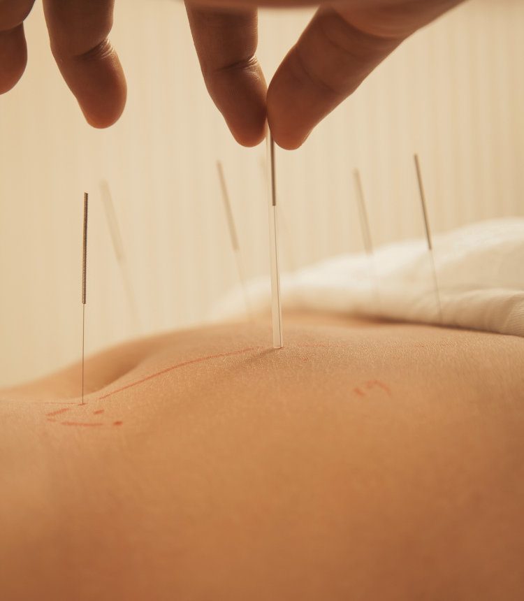 equilibriointegral_acupuntura_18