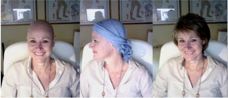 Quimioterapia: caída del pelo